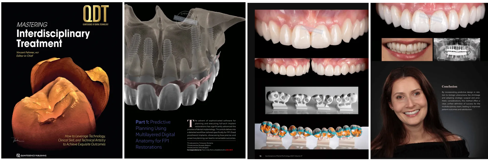 Full-Arch Implants: FP1 — A Digital Reinterpretation