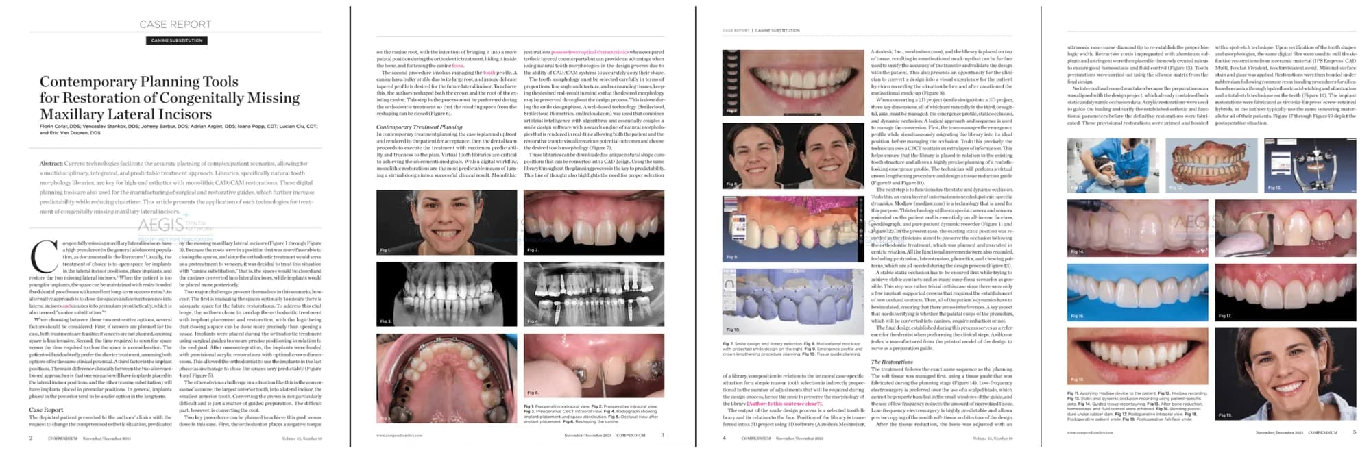 Contemporary Planning Tools for Restoration of Congenitally Missing Maxillary Lateral Incisors
