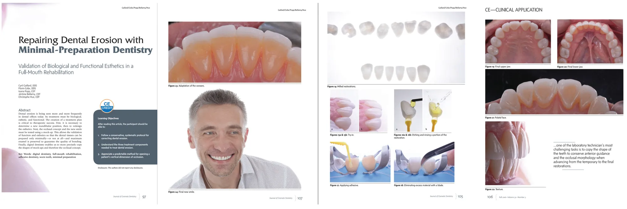Repairing Dental Erosion with Minimal-Preparation Dentistry