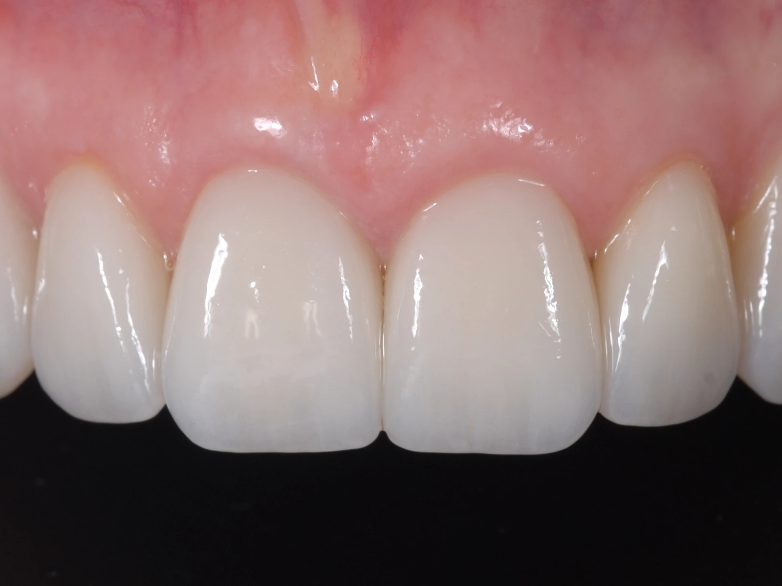 Gingiile vindecate în jurul noilor dinți