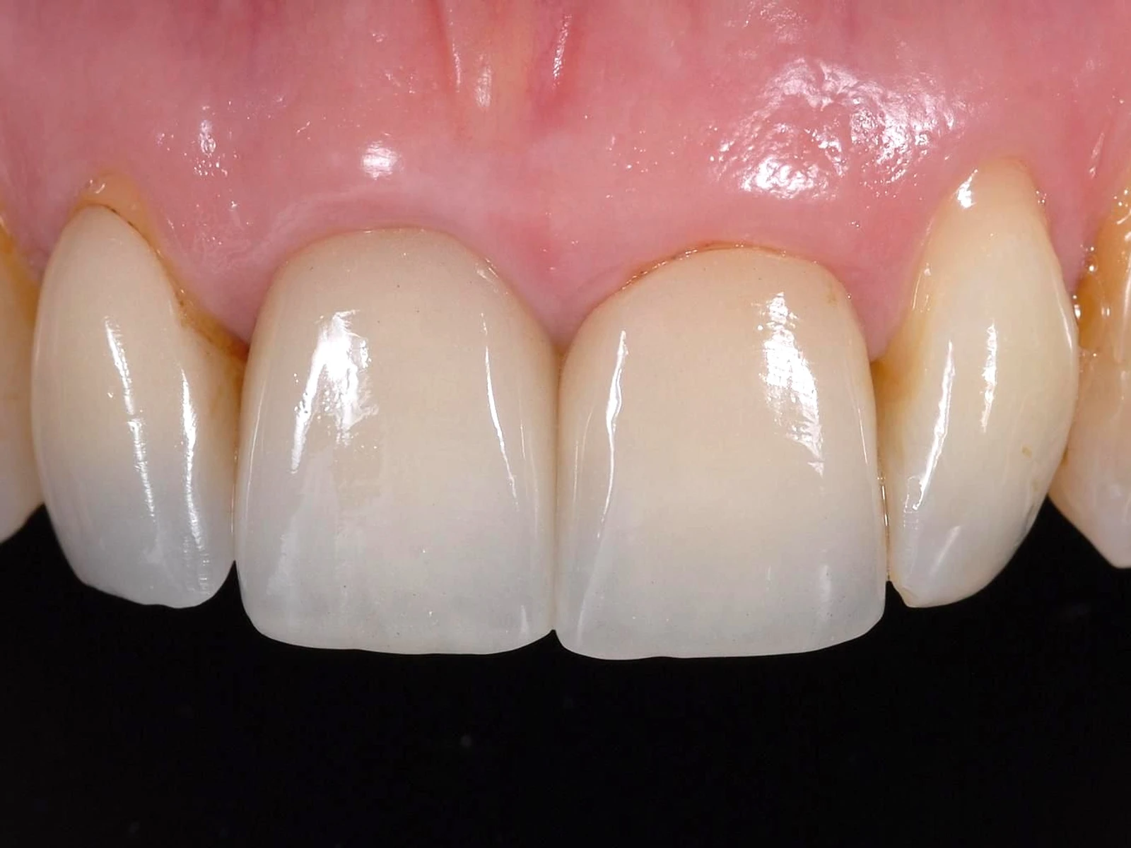 Gingiile și dinții înainte de tratament