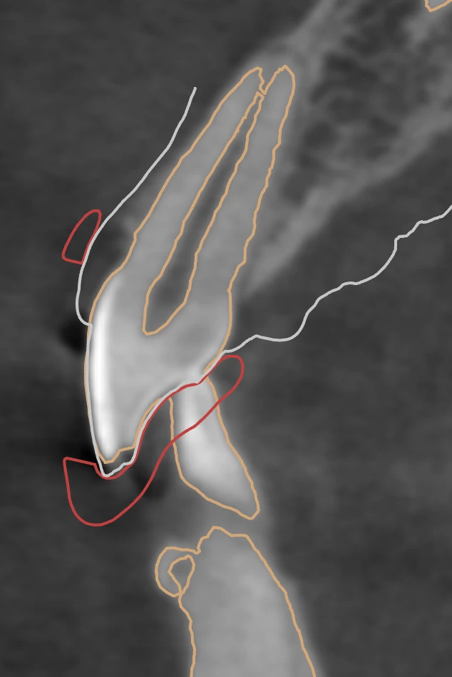 Secțiune radiografică 3D cu nivelurile planificate ale gingiei și osului