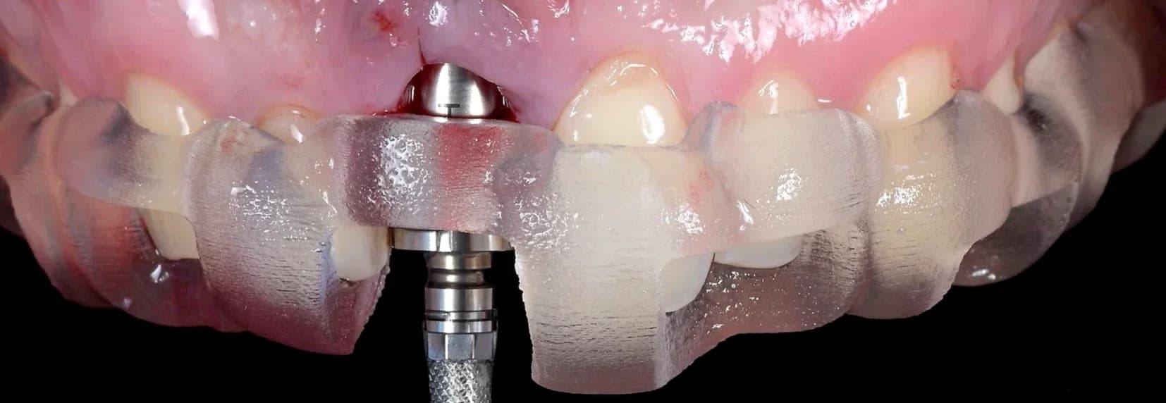 Implantul inserat printr-un ghid chirurgical realizat după design