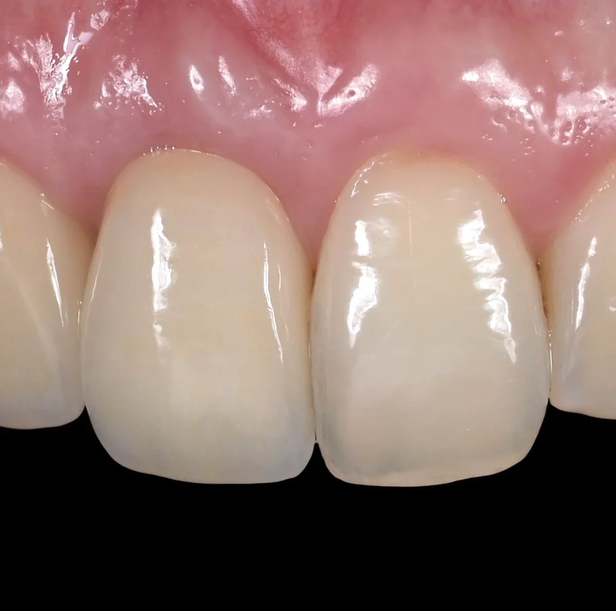 Coroana pe implant vindecată, lângă dintele natural