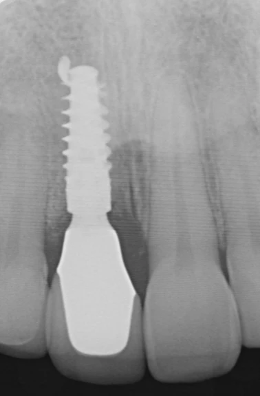 Radiografia implantului și a coroanei