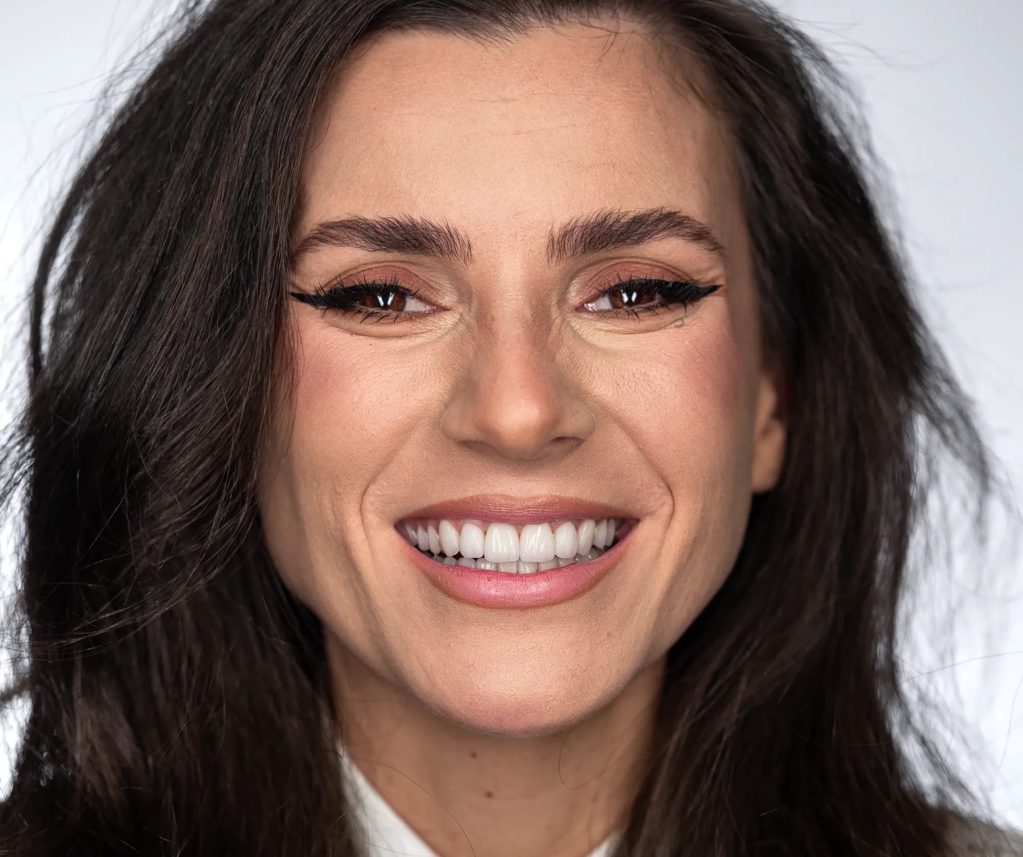 Alignere și chirurgie ortognatică, finalizate cu fațete