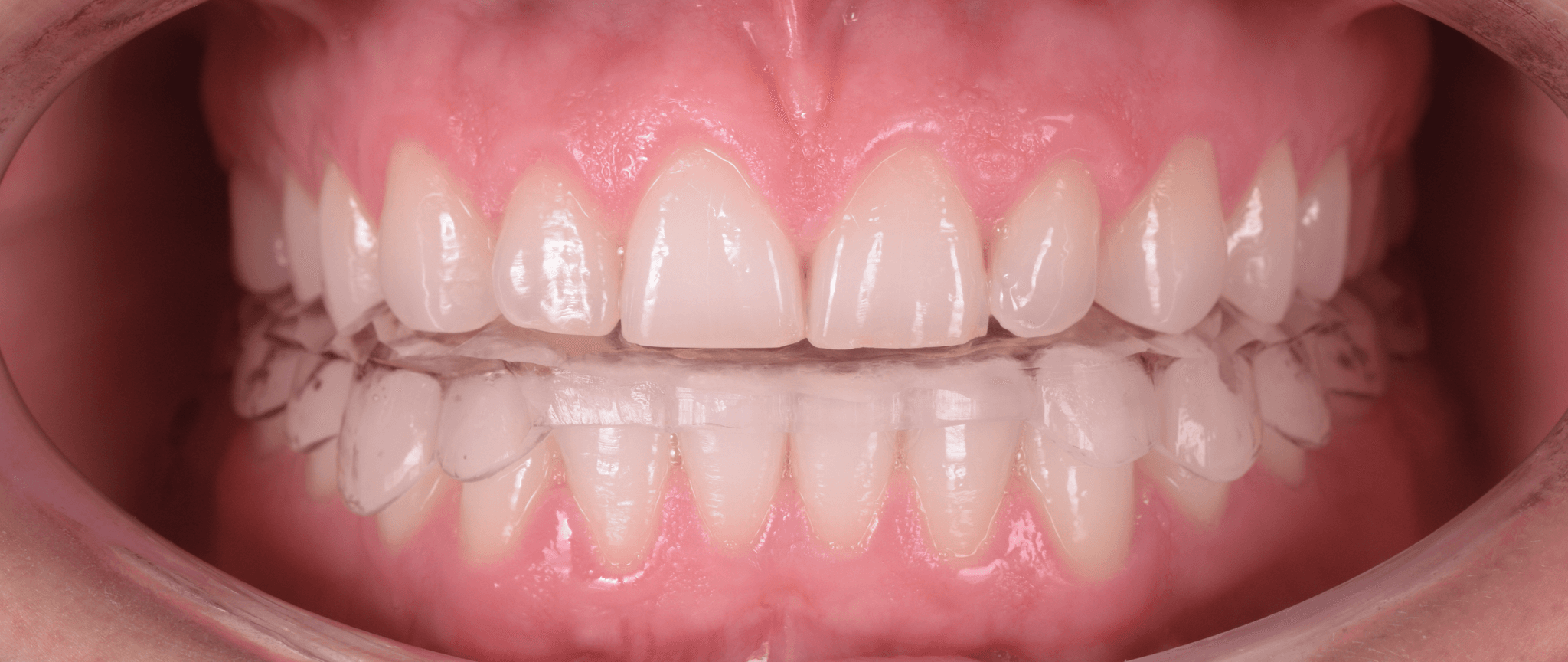 LASCU_splint_DSC_4538_crop_