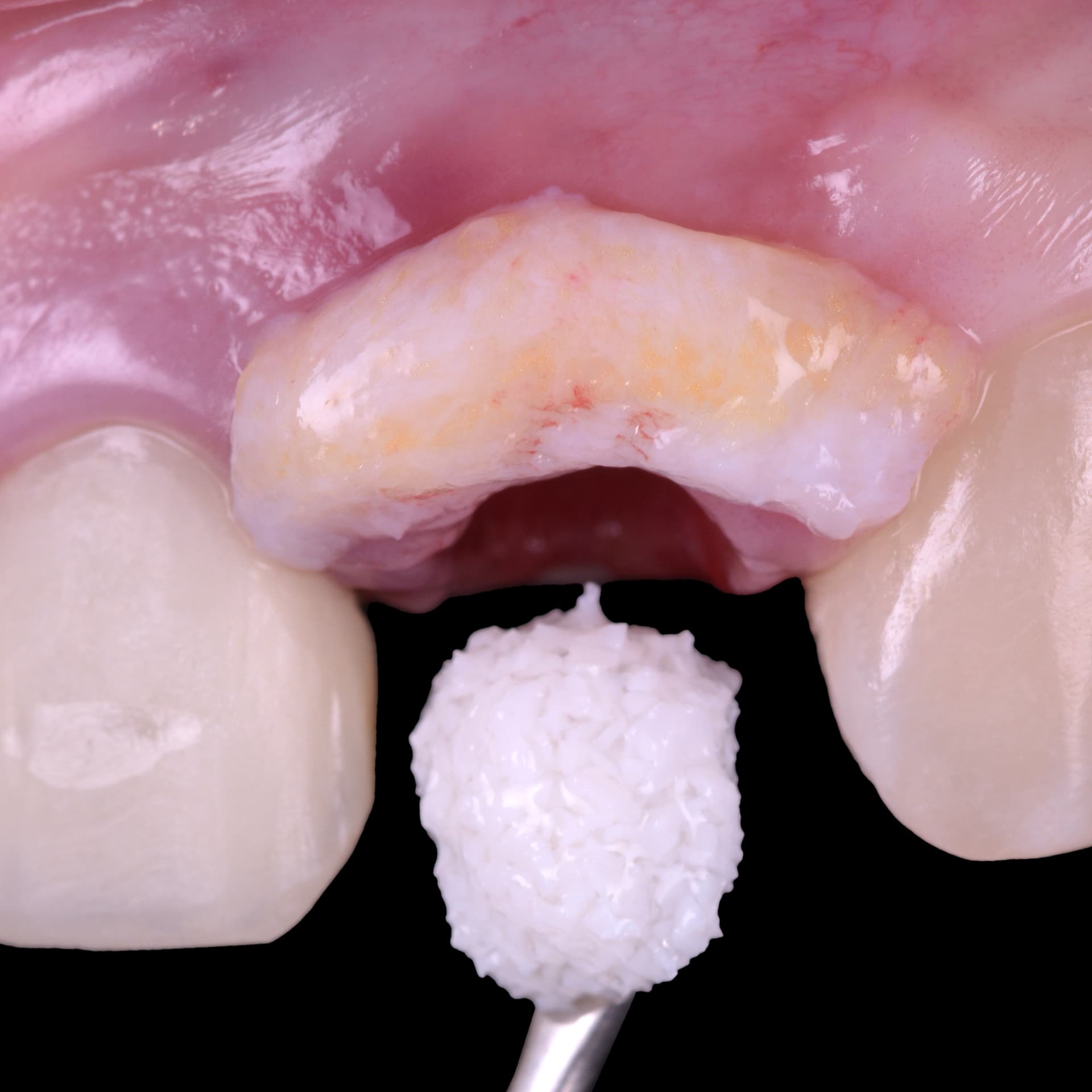 implant stmn