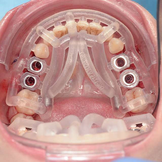 surgical-drill-guide