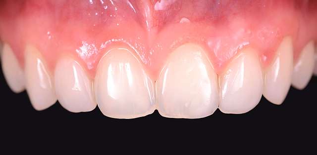 smile-transformation-veneers