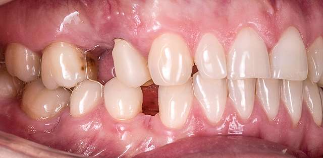 teeth-5