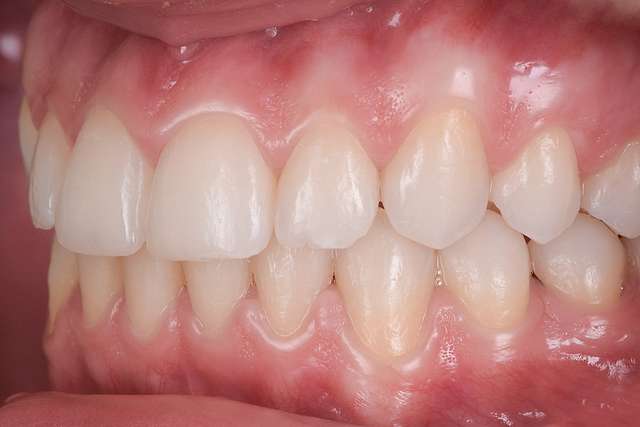 teeth-6