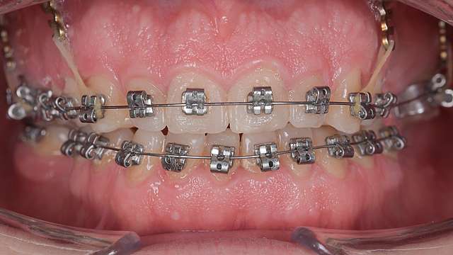 teeth-1