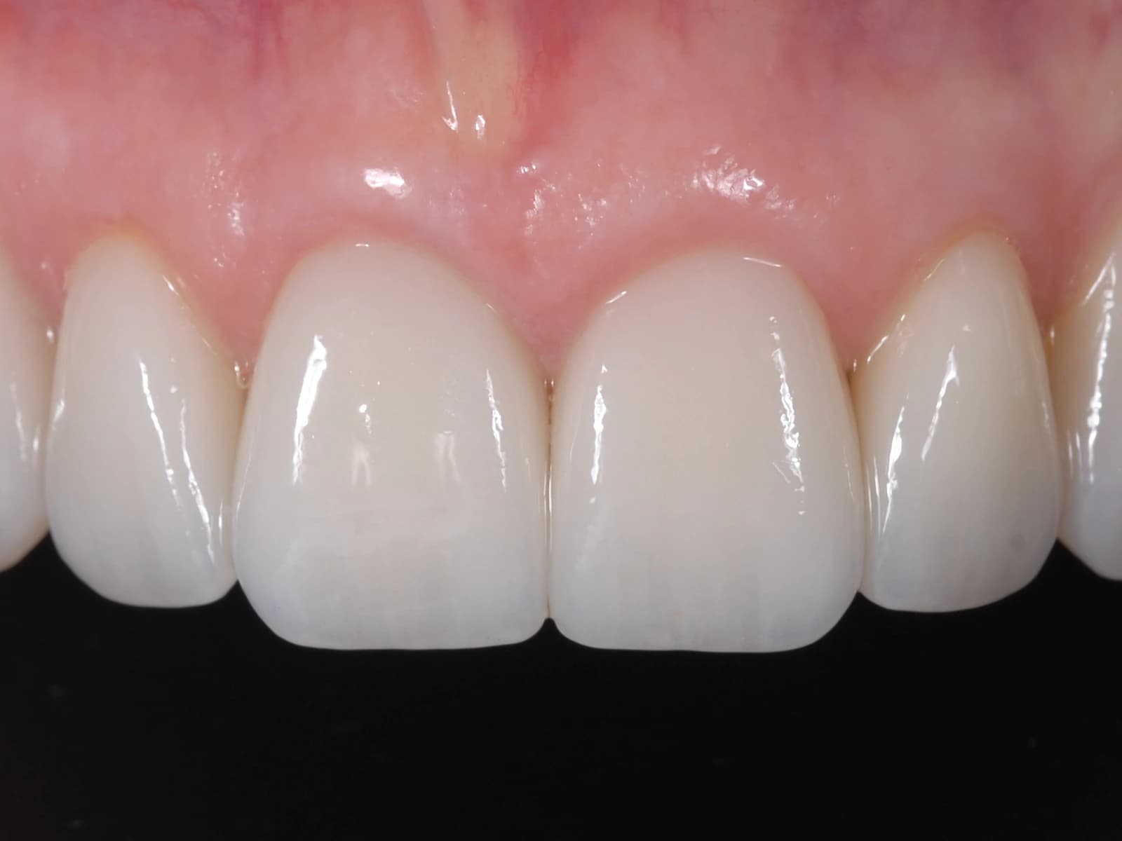Gingiile vindecate în jurul noilor dinți