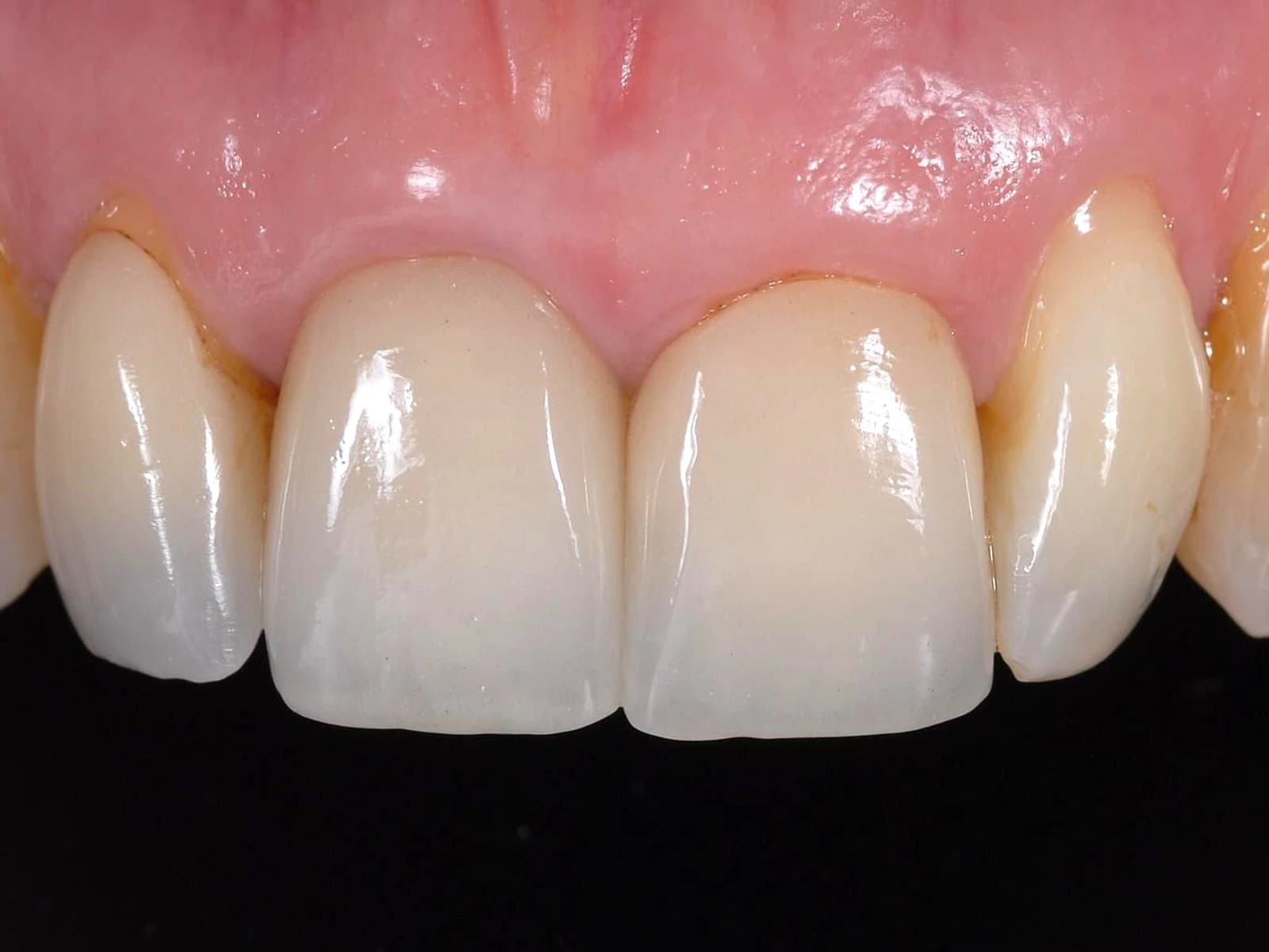 Gingiile și dinții înainte de tratament