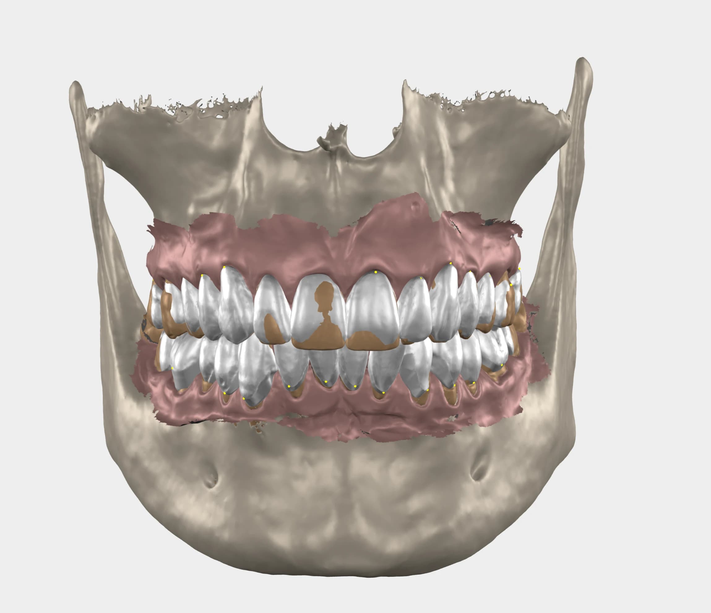 Dinții și gingiile planificate, proiectate 3D peste scanarea maxilarelor