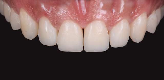 after-composite-fillings