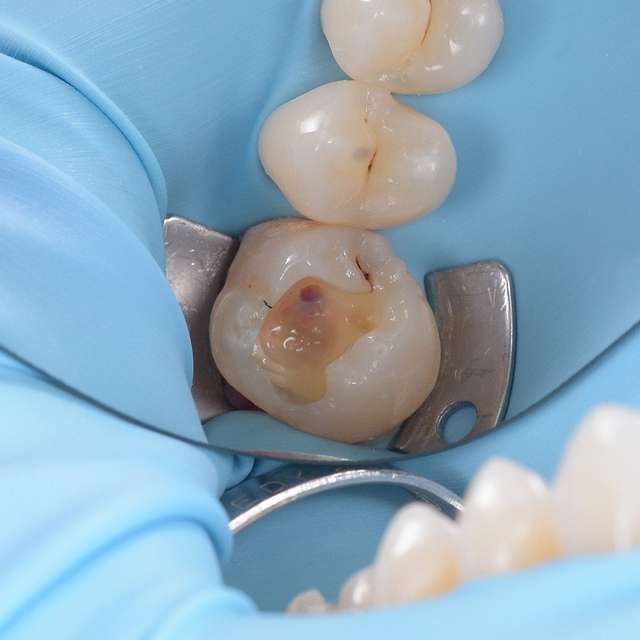 fillings-cavities